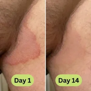 Alisanda™ - Antifungal Tea Tree Soap Bar