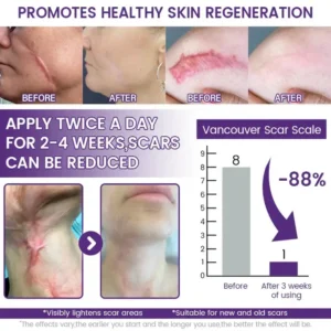 Alisanda® ReGenScar Rapid Recovery Scar Gel