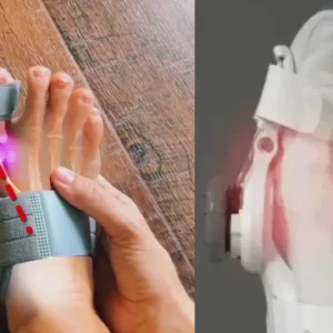 Alisanda® - Non-Surgical Relief for Bunion Pain