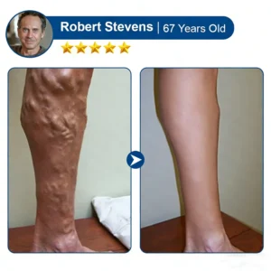 Alisanda® Vein Contour Micro-Patches: The 7-Day Transformation for Varicose Veins