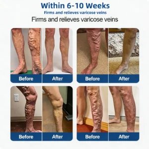 Alisanda® Vein Contour Micro-Patches: The 7-Day Transformation for Varicose Veins