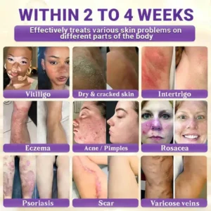 Watch Them Fall Off! ✨ Alisanda® 10-in-1 Skin Clear