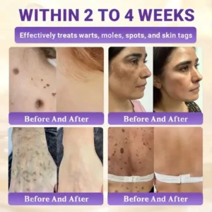 Watch Them Fall Off! ✨ Alisanda® 10-in-1 Skin Clear