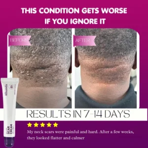 Alisanda Scar Cream – Advanced Treatment for Raised & Keloid Scars