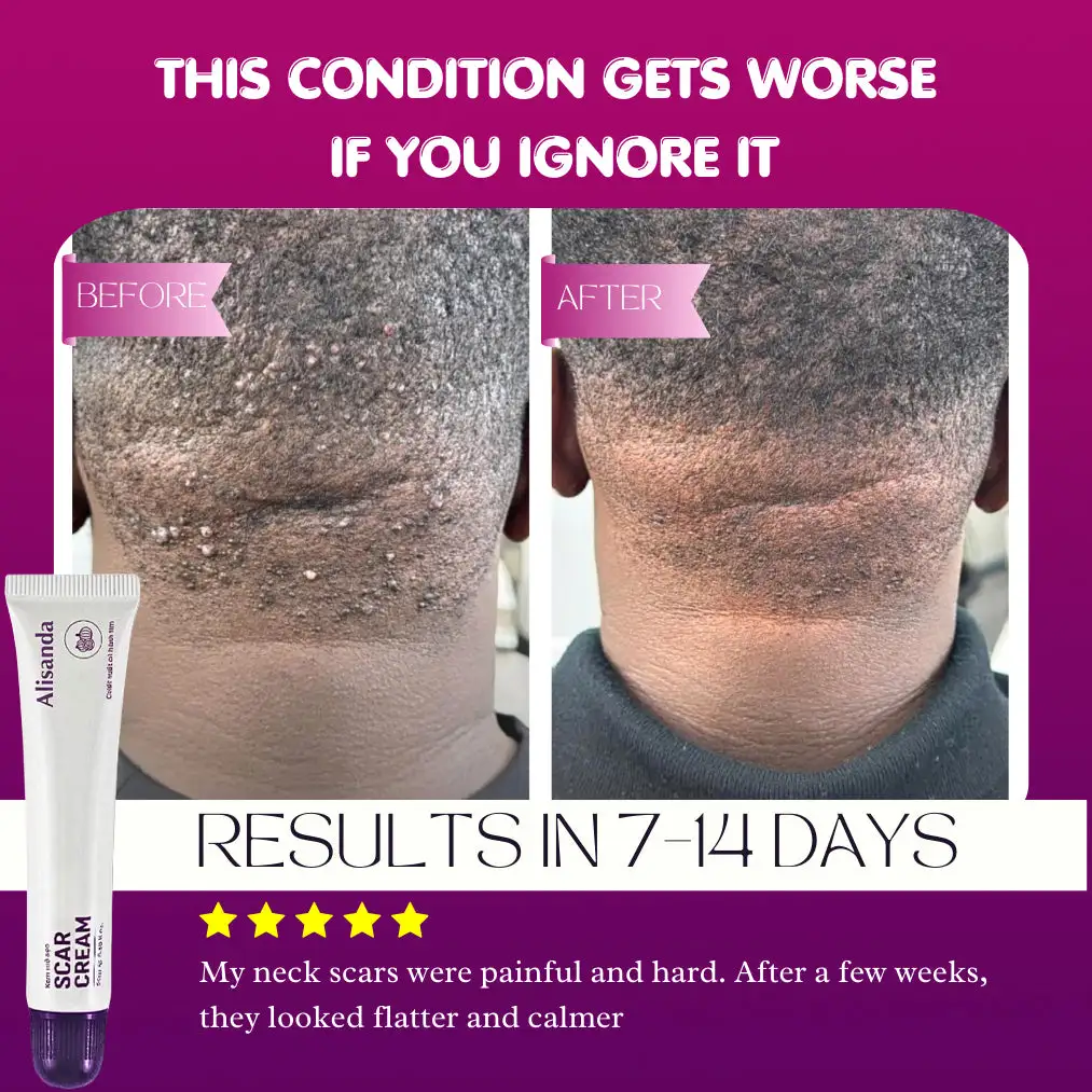 Alisanda Scar Cream – Advanced Treatment for Raised & Keloid Scars