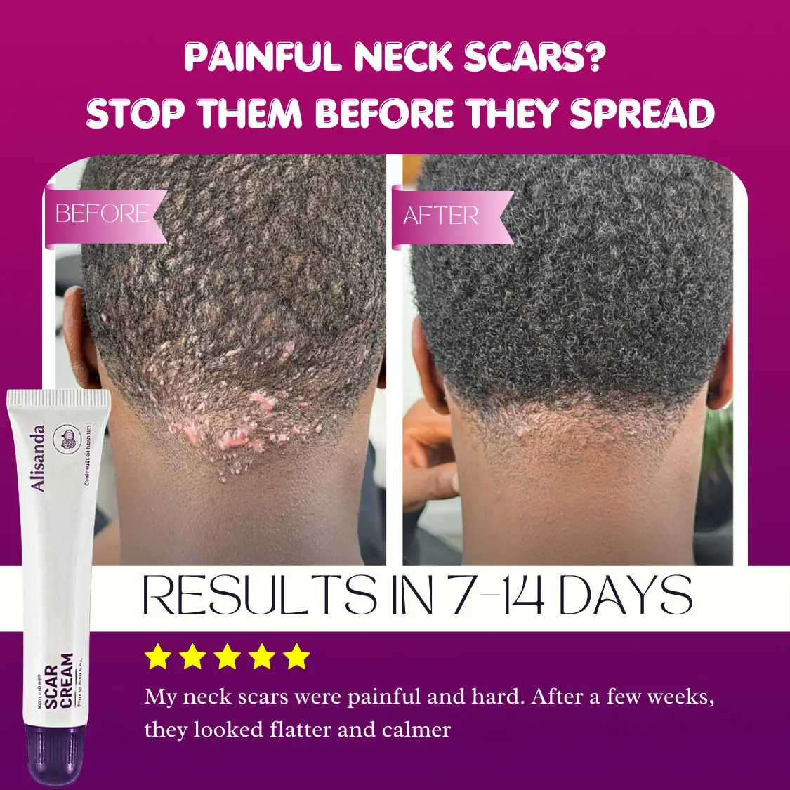 Alisanda Scar Cream – Advanced Treatment for Raised & Keloid Scars