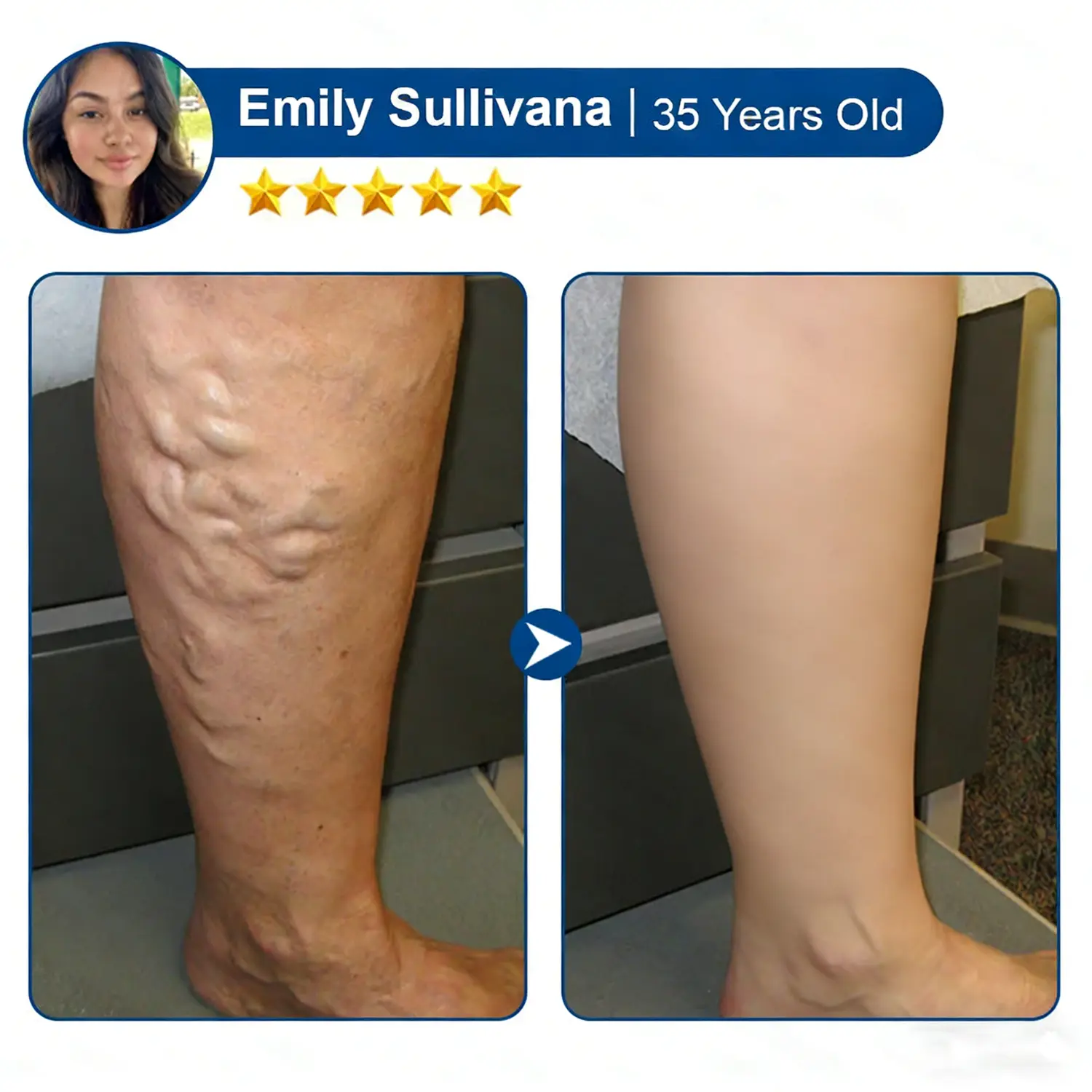 Alisanda® Vein Relief Patch|Smoother-Looking Legs