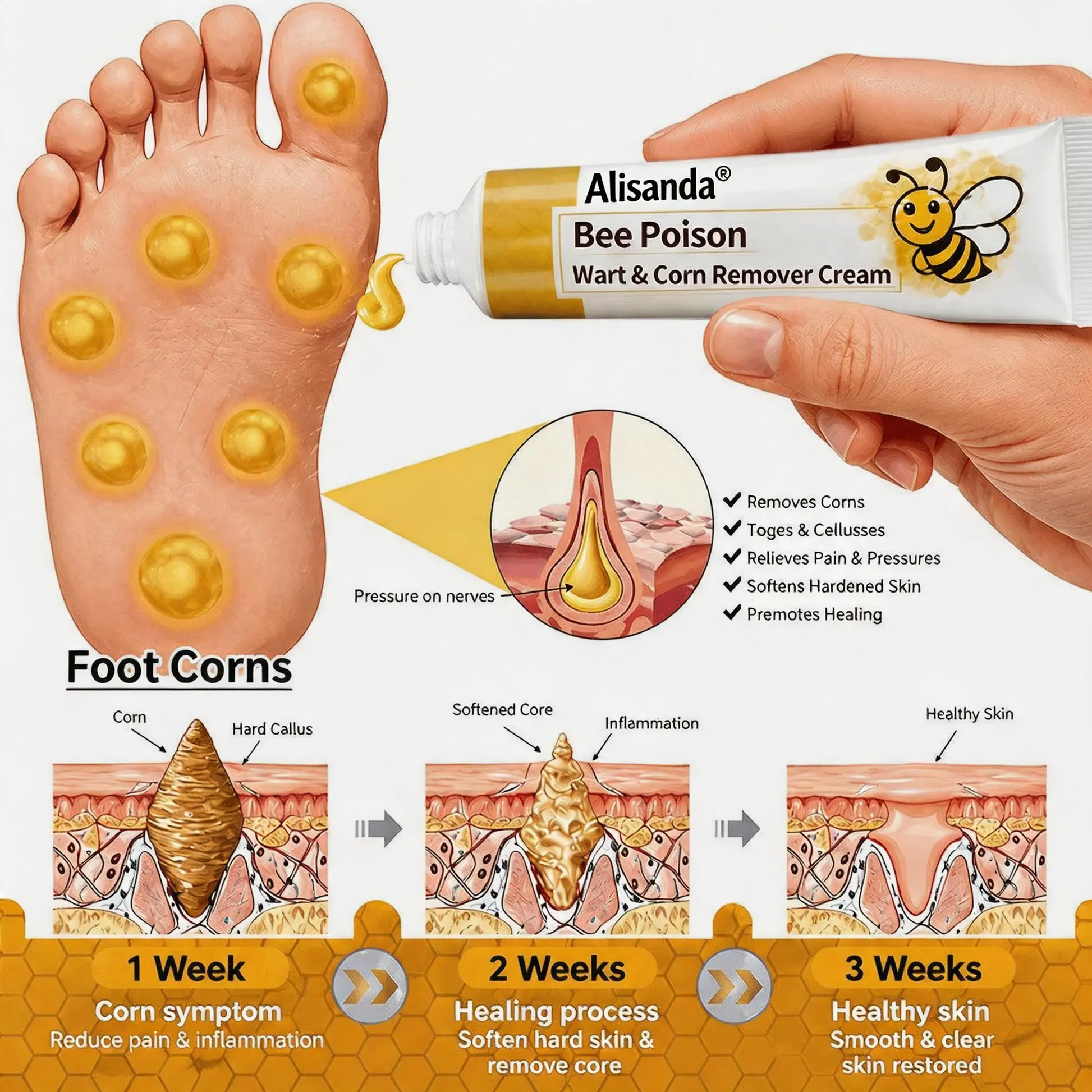 👨⚕️Alisanda®Bee Poison Wart & Corn Remover Cream⚡