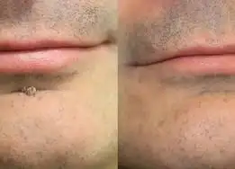 Alisanda®2-in-1 Microneedle & Hydrocolloid Patch🍀| Removes Raised Moles, Acne, Flat Warts & Skin Tags