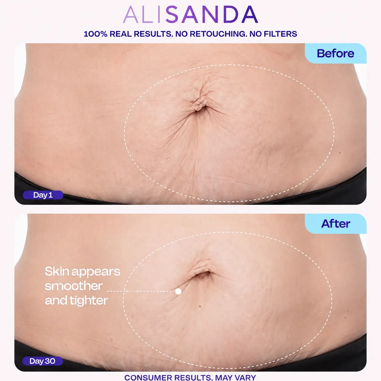 💜 ALISANDA Tighten & Smooth Belly Cream – Firming, Stretch Mark & Loose Skin Care ✨