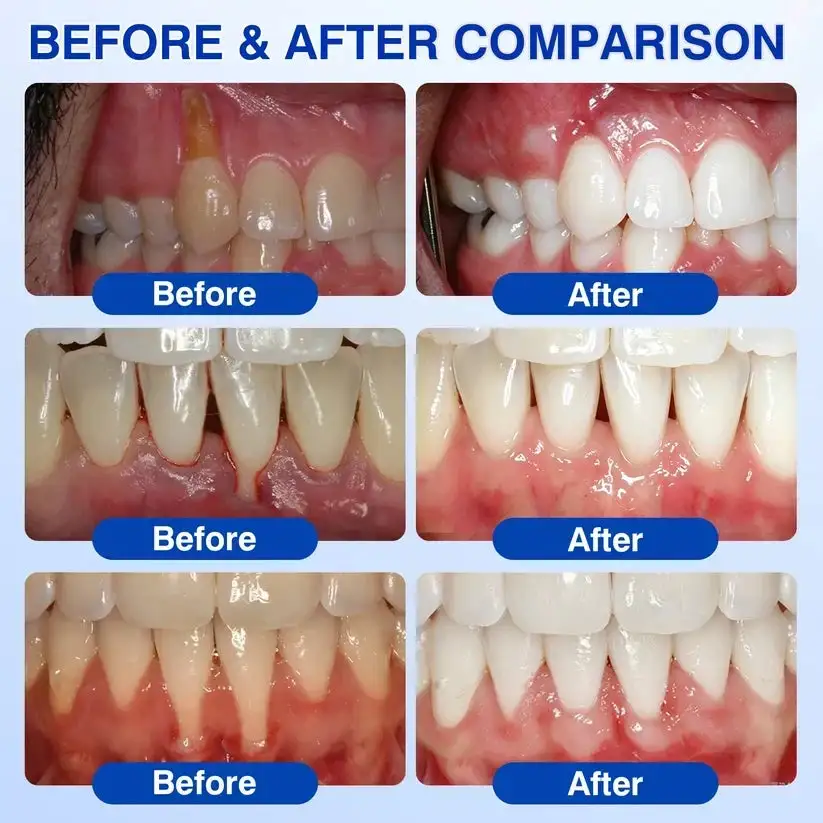 🇺🇸🏆🦷✨Alisanda® GumRevive Periodontal Repair Gel
– Savorselects